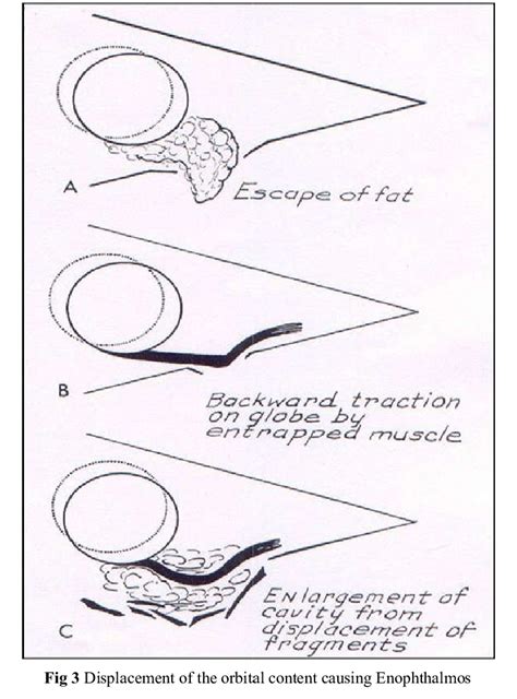 Coronal CT scan showing Entrapment of Inferior Rectus Muscle | Download ...