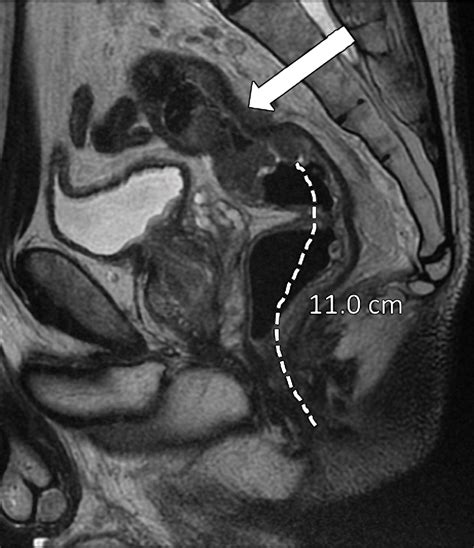 MRI of Rectal Cancer: Tumor Staging, Imaging Techniques, and Management ...