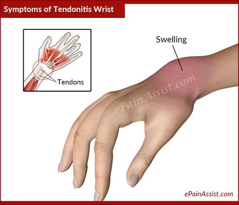 Signs and Symptoms of Tendonitis Wrist or Wrist Tendinitis | Health and ...