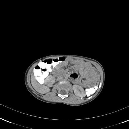 Bilateral kidney malrotation | Radiology Case | Radiopaedia.org