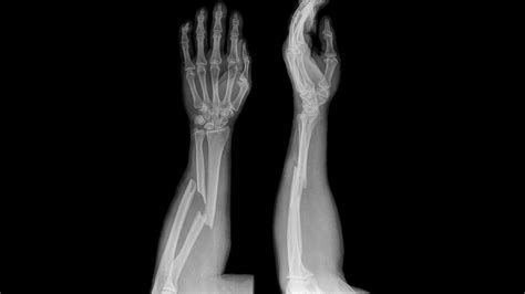 Broken Arm Bones X Ray