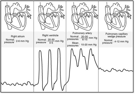 Pulmonary Artery Catheter Waveforms