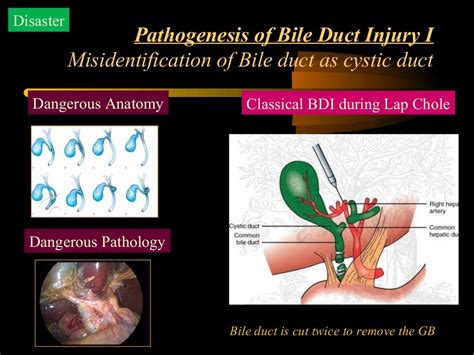 Bile duct injury during laparoscopic cholecystectomy