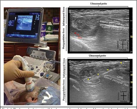 Facial Nerve Ultrasound