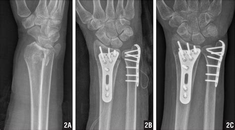 Left Distal Ulna Fracture