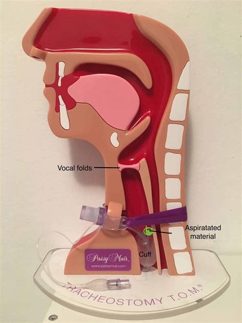 Cuffed Tracheostomy Tube