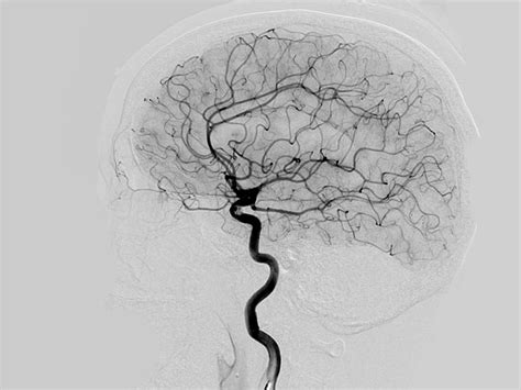 What Is a Cerebral Angiography?