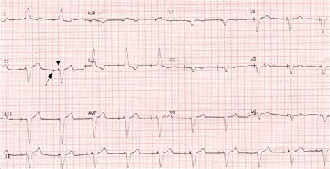 ECG showing atrial and ventricular pacing spikes – All About Cardiovascular System and Disorders