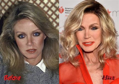 Donna Mills Plastic Surgery: Great Example or Epic Fail? - Plastic ...