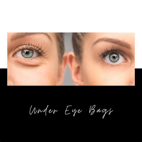 Bags Under Eyes? Causes, Treatments and Solutions