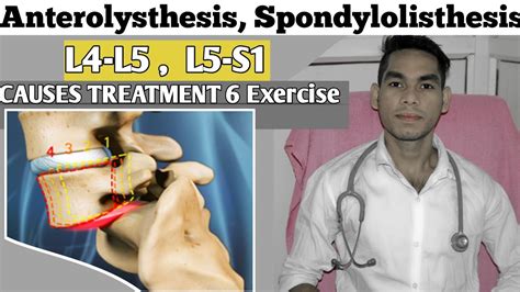 Anterolisthesis spondylolisthesis L5-s1, spondylolisthesis Treatment, Exercise Low back pain ...