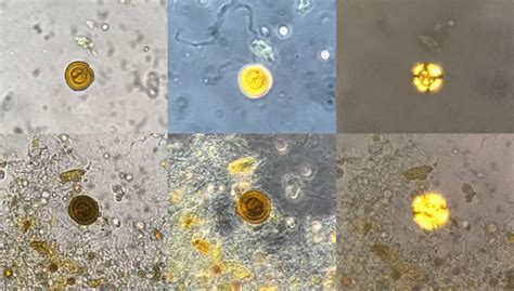 Urine Sediment of the Month: Pathologic Crystals in the Urine - Renal Fellow Network