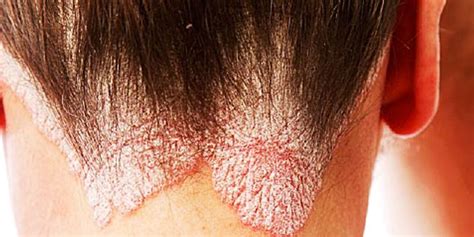 4 Types of Dandruff and How to Treat Them