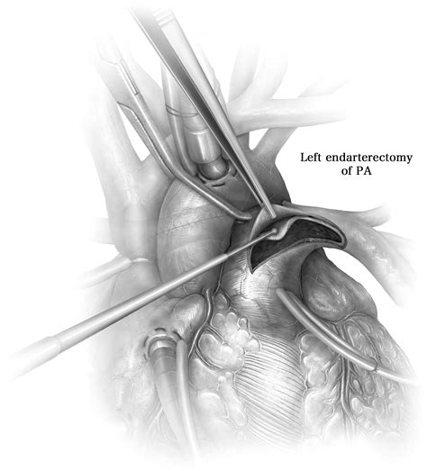 Technique of Pulmonary Thromboendarterectomy - Operative Techniques in ...