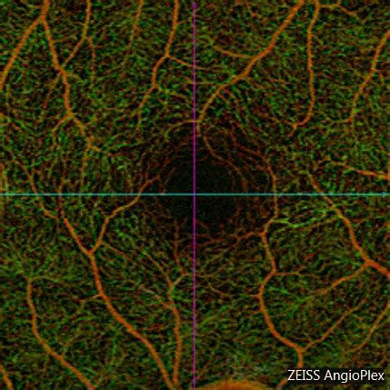 OCT Angiography - Retina Eya Care, P.C.