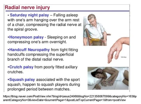 Radial Nerve Injury