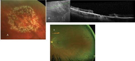 A Field Guide to Retinal Holes and Tears