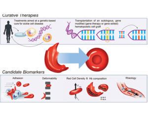 Reaching toward a cure for sickle cell disease