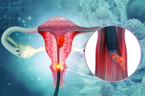 Endometrial Biopsy: Procedure, Purpose, and Results