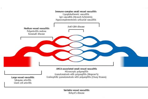 Vasculitis International - Overview Diseases