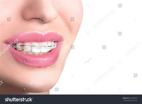 Closeup Ceramic Braces On Teeth. Beautiful Female Smile With Braces ...