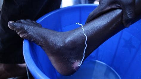 Elimination of Guinea Worm Disease in South Sudan through multi ...