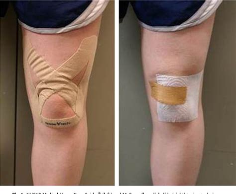 Figure 1 from The effects of two therapeutic patellofemoral taping techniques on strength ...