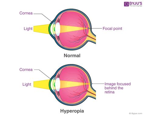 Visual Defects Myopia Hyperopia And Astigmatism - HooDoo Wallpaper