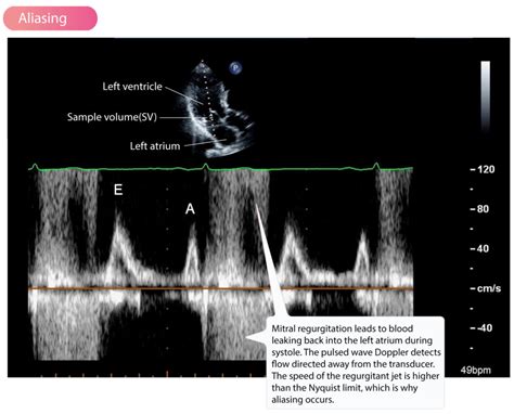 Doppler de onda Pulsada: ECG y ECO | Lacaleya