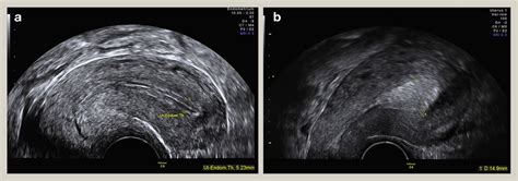 Ultrasound in obstetrics and gynaecology - Obstetrics, Gynaecology and ...