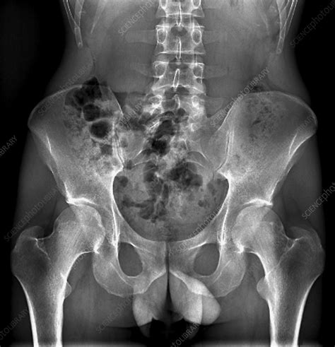 Male pelvis bones and joints, X-ray - Stock Image C033/7348 - Science Photo Library