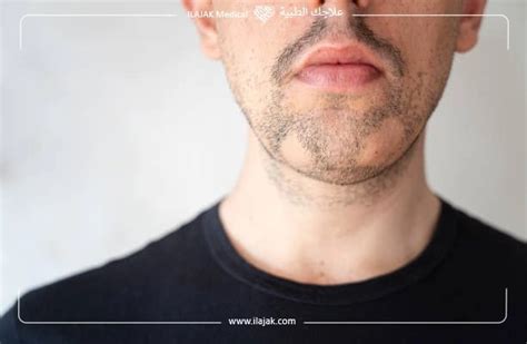 Beard Hair Loss: Causes & treatment | ILAJAK Medical