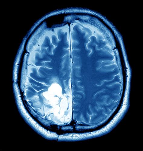 Brain Tumor Overview - Harvard Health