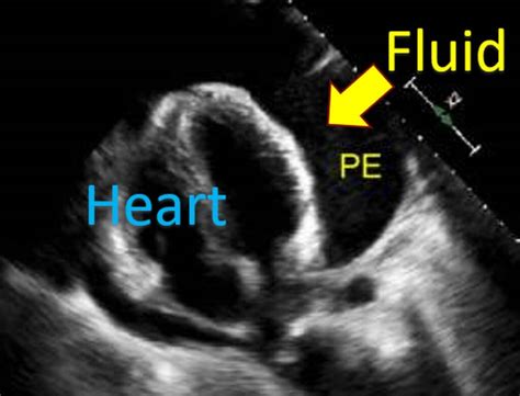 What is pericardial effusion? – All About Heart And Blood Vessels