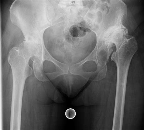 Complex THA for Severe Hip Dysplasia – Darwin Chen, MD