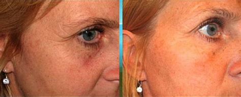 Light Therapy for Wrinkles: Best Red Light, LED Light, Reviews of Laser ...