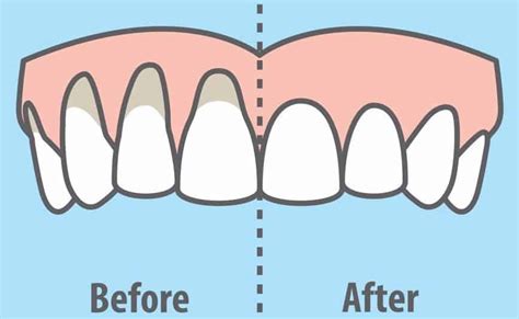 Truth About Gum Recession Causes | Newton Drive Family Dentistry ...