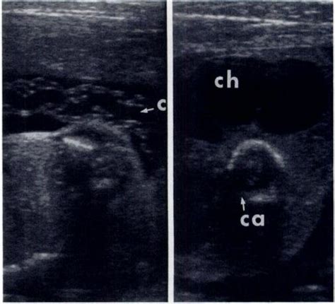 -Acardiac twin. A, Sonogram of nonhydropic normal twin shows a ...