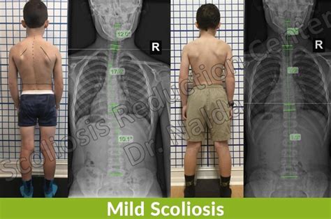 Mild Scoliosis - Symptoms, Treatment, and Surgery