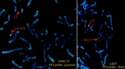 Constitutional rearrangements of chromosome 22 as a cause of ...