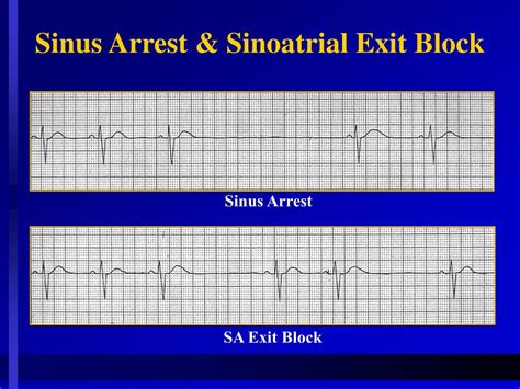 PPT - Principles of Cardiac Pacing PowerPoint Presentation, free download - ID:454515