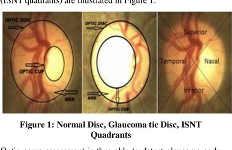 ANN Glaucoma Detection using Cup-to-Disk Ratio and Neuroretinal Rim ...