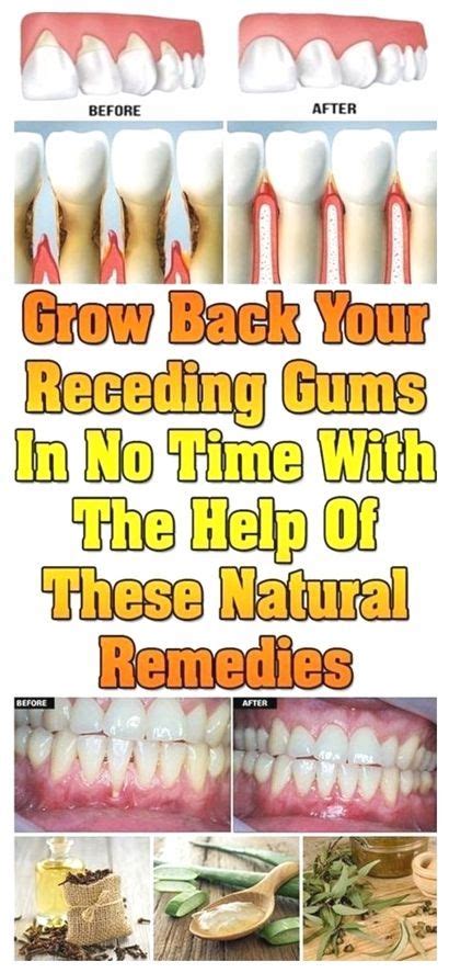 Receding Gums | Receding gums, Natural remedies, Gum health