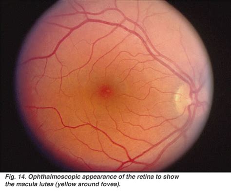 pathology - Explanation of the ‘cherry red spot' in Tay Sachs disease - Biology Stack Exchange