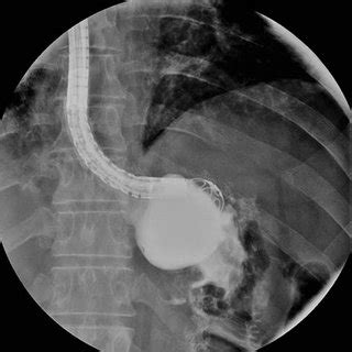 Giant chronic gastrogastric fistula following gastric bypass. a... | Download Scientific Diagram