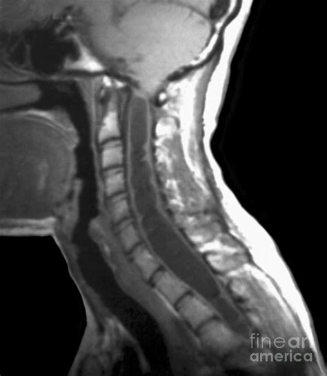 Spinal Cord Cyst, Mri Scan Photograph by Zephyr - Pixels