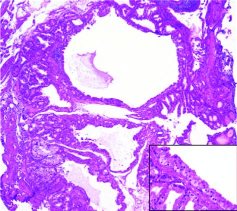 Brunner gland cyst. Cystic dilatations of Brunner glands immediately ...