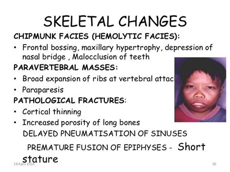 Beta Thalassemia Chipmunk Facies