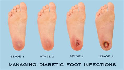 Diabetes and Your Feet | Premier Foot & Ankle Center | 5 Stars ...