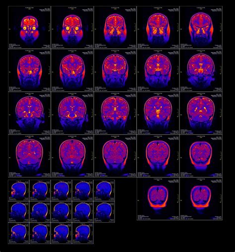 Structural MRI changes in bipolar disorder - NeuRA Library